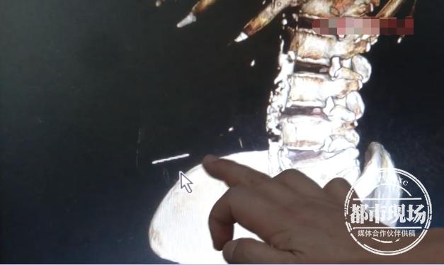 针灸毫针断体内不取出来有事吗,针灸断针取出术