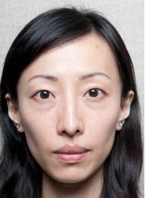 打瘦脸针有什么副作用,咬肌发达打瘦脸针有什么副作用吗