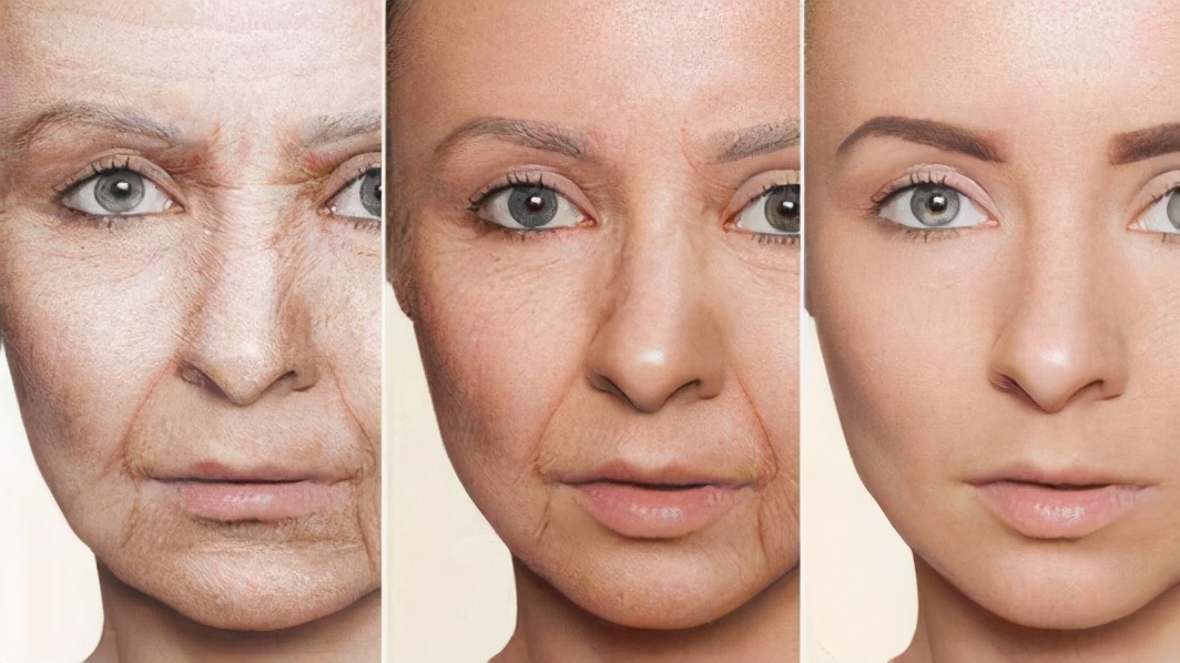 面部法令纹显老怎么改善,法令纹显老10岁三种方法帮助缓解