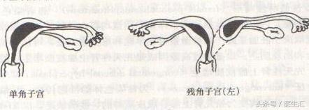单角子宫妊娠，你遇到过吗？