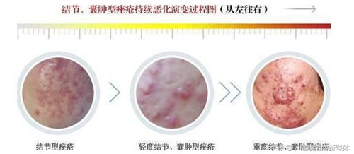 15岁男孩挤青春痘感染,挤痘感染致死案例