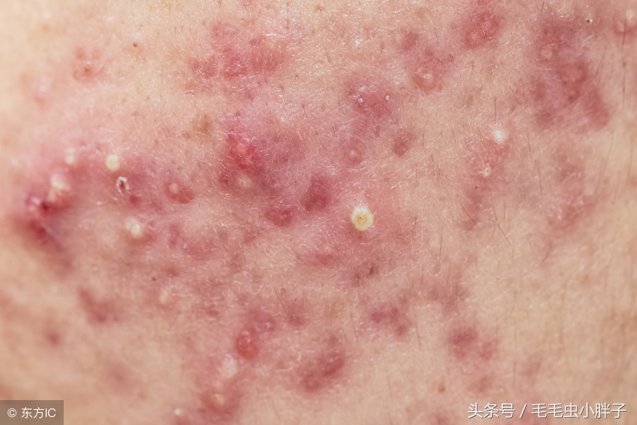 痘痘肌的处理及应对方法,痘痘大作战有没有秘籍