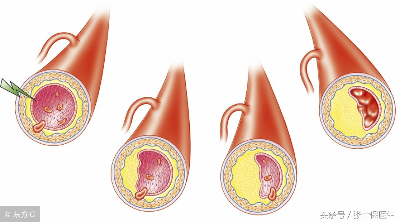 颈动脉多发斑怎么治疗,左侧颈动脉见多发斑块回声