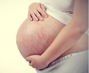 最好的预防妊娠纹的油,妊娠纹长后还能抹油消除吗