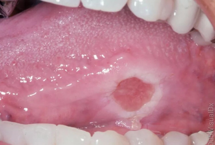 小孩嘴唇鹅口疮什么样,小孩长鹅口疮是缺维生素多少