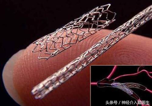 脑血管畸形介入手术是放支架吗,脑部血管支架介入手术风险大吗