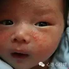 急疹湿疹如何快速治好,麻疹风疹水痘幼儿急疹的区别