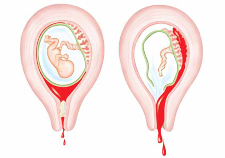 孕早期阴道出血什么症状,孕早期阴道出血有什么症状