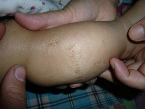 宝宝出现湿疹怎么办,宝宝的湿疹反反复复的怎么办