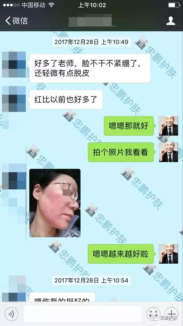 激素脸发红发热脱皮怎么办呢,激素脸为什么会扩散到脖子上代谢