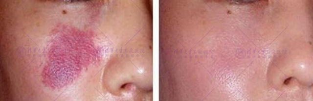 激光祛痣留下坑会长平吗,激光祛痣的疤痕会消失吗