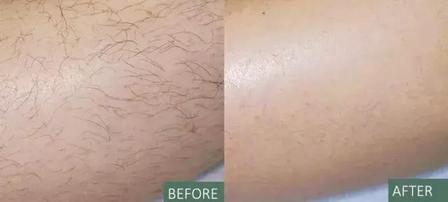 1秒脱毛,如何在一分钟内脱毛