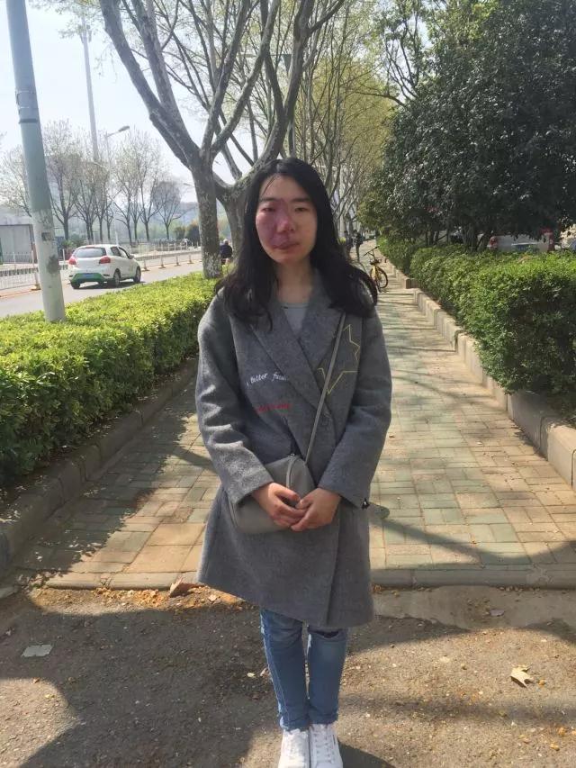 胎记患者张群,张群祛胎记