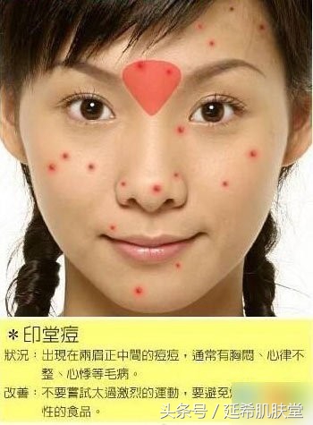 下巴长满痘痘是什么原因怎么调理,下巴不停冒脓包型痘痘怎么样调理