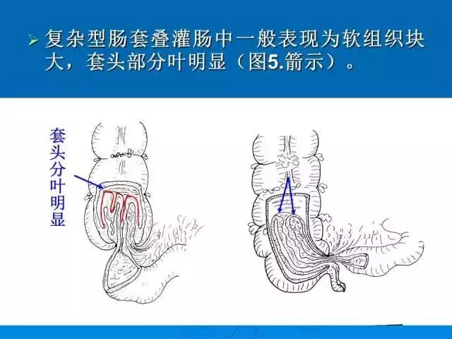 小儿肠套叠空气灌肠需要注意事项,儿童肠套叠空气灌肠要不要住院