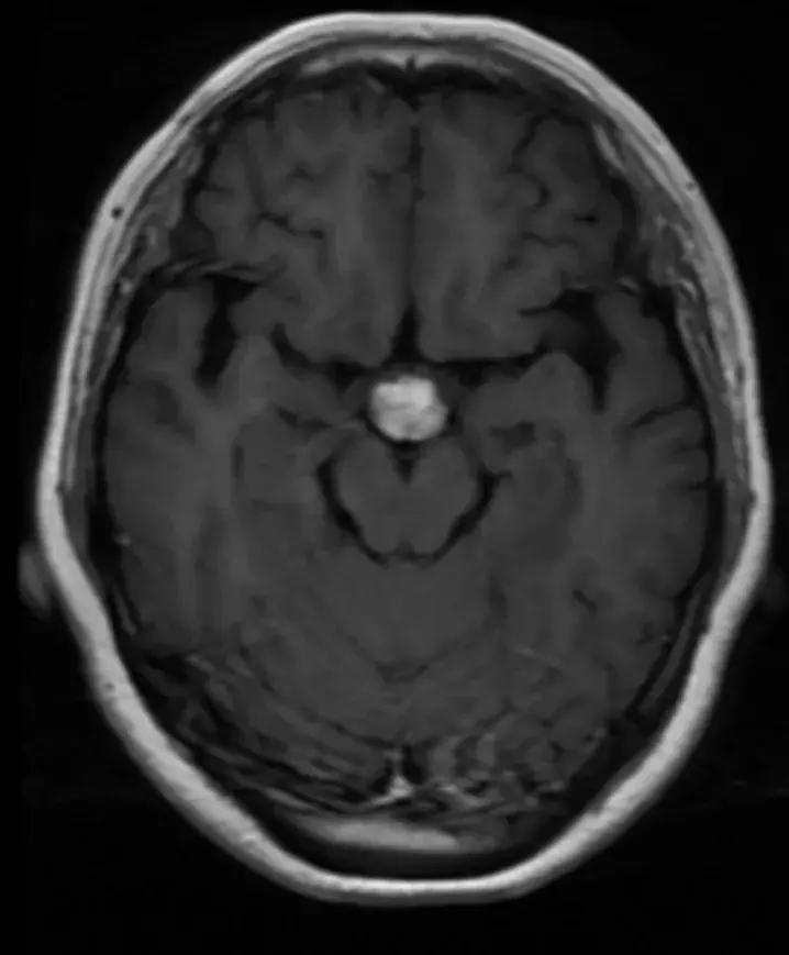 复旦大学附属中山医院放射科病例讨论（八十四）