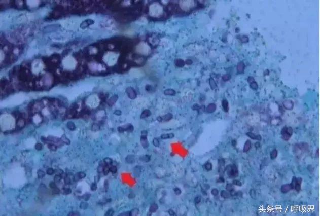 肝移植患儿术后出现「肺炎」,抓住真凶的重要依据是什么?