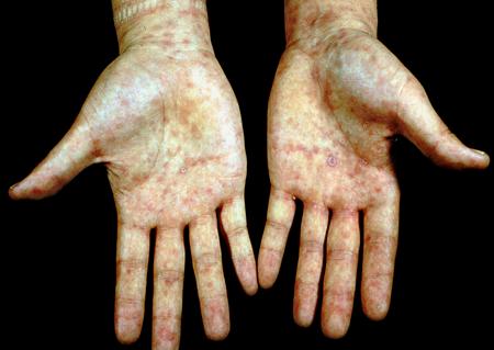 全方位带你认识性病，开启“预防性病”小贴士