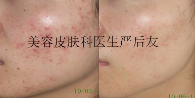 皮肤科医生是怎么祛痘祛痘坑的,皮肤科专家美容祛斑方法