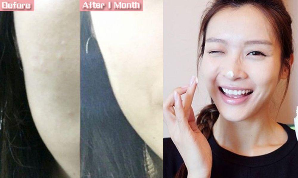 娥罗纳英祛粉刺效果如何,娥罗纳英软膏治粉刺好吗