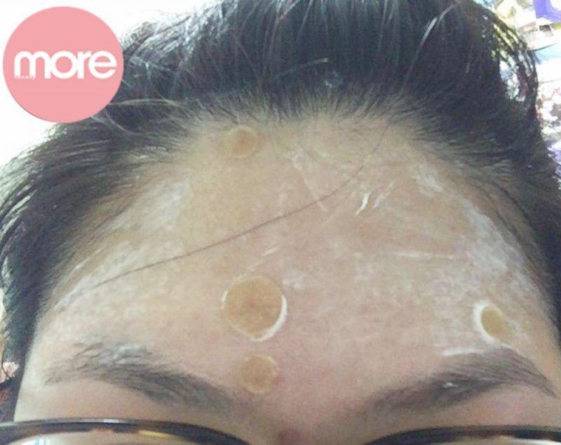 娥罗纳英祛粉刺效果如何,娥罗纳英软膏治粉刺好吗