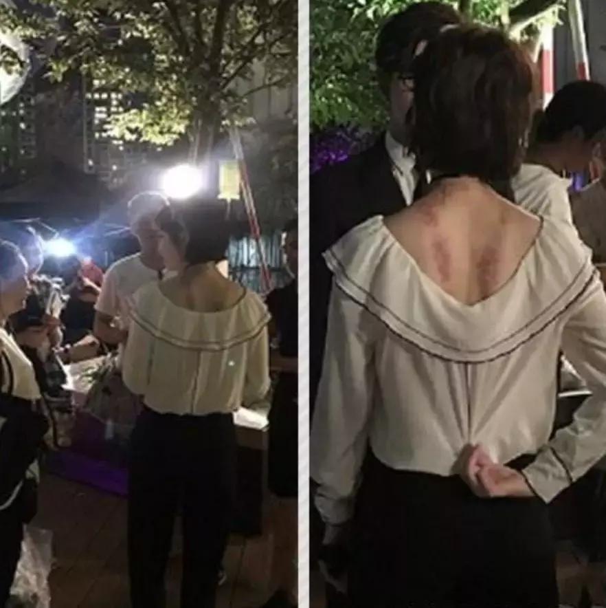 触目惊心！杨丞琳阿娇等人把刮痧过度神话，专家打脸：根本没效果