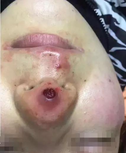 不动刀的隆鼻方法是什么,不动刀不打针的隆鼻的方法