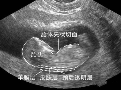 nt值厚会是胎儿脖子厚吗,nt结果胎儿左下肢异常准确吗