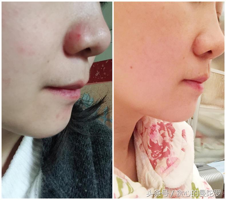 茶树精油凝胶祛痘测评,阿芙茶树精油祛痘精华黄色