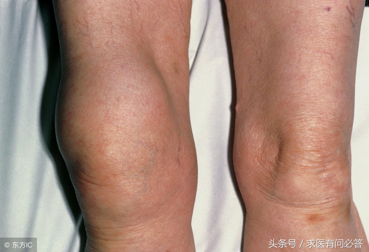 滑膜炎饮食上需要注意什么,关节炎和滑膜炎饮食吃什么好