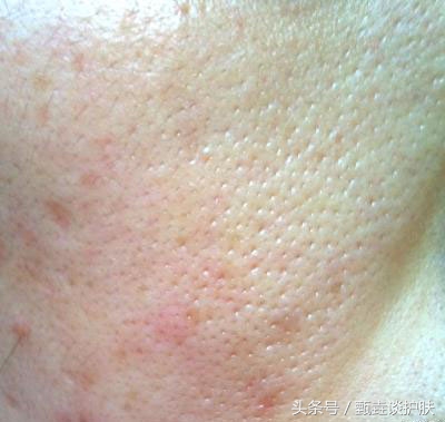 如何真正改善毛孔粗大,毛孔粗大油腻如何改善