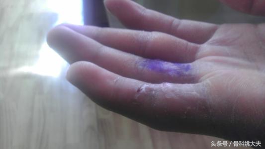 筋断了还能接回来吗,筋断了接上后能干活吗