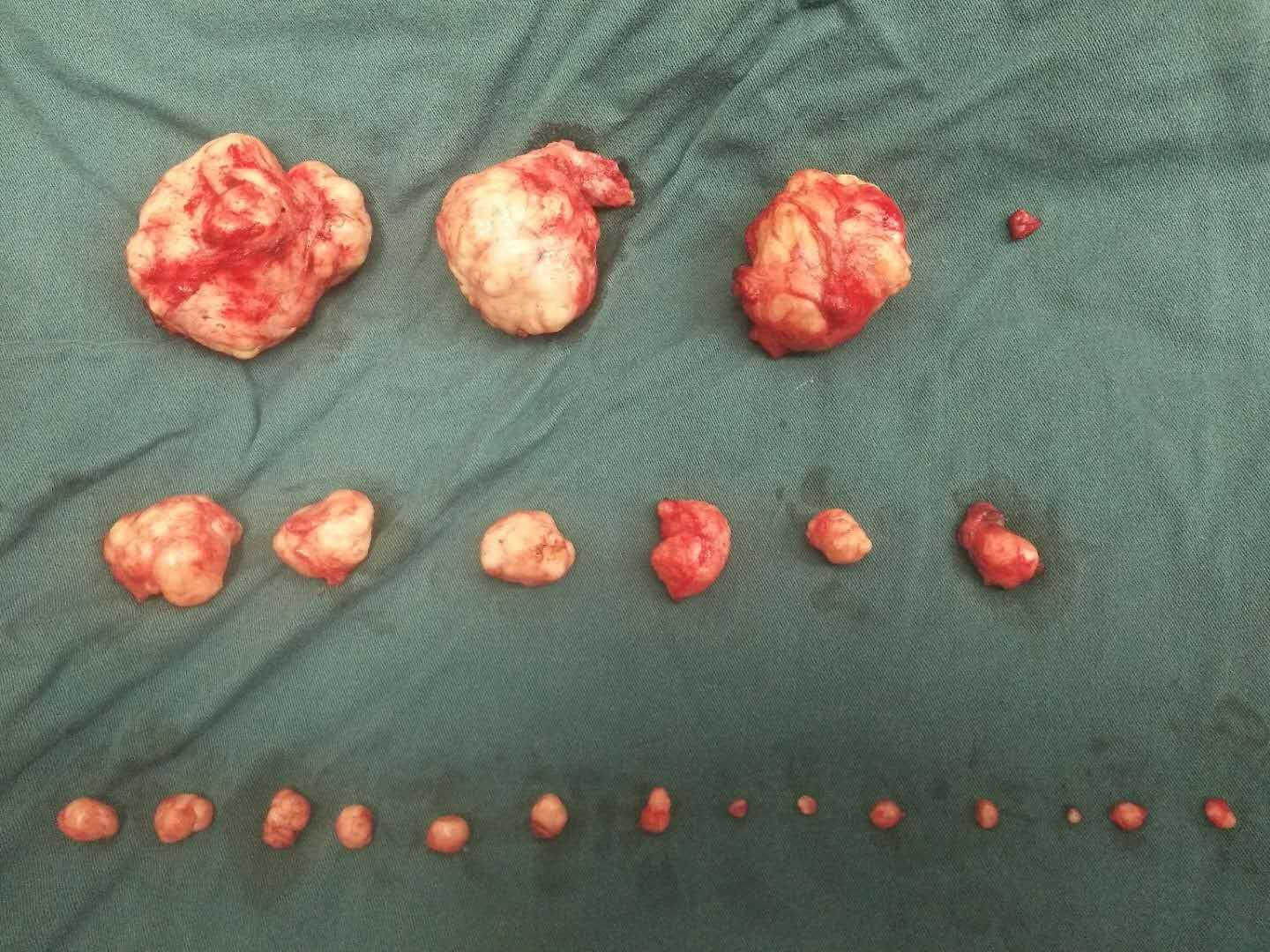 2米饭桶遇现实版滚蛋吧肿瘤君,滚蛋吧肿瘤君真人版