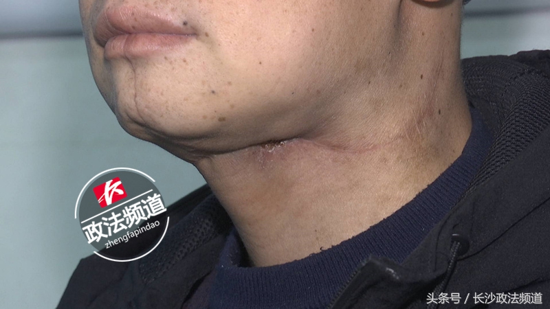 嚼槟榔14年得了癌症,吃槟榔得癌的33岁小伙子