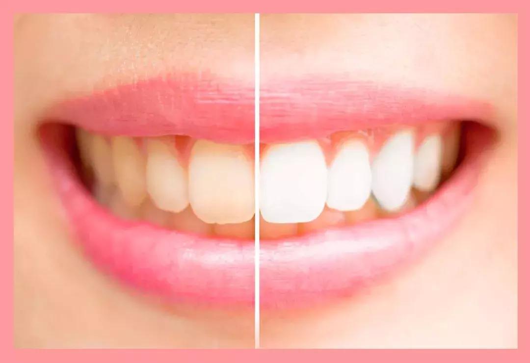 牙黄还不整齐，再美张嘴也输了你知道吗？