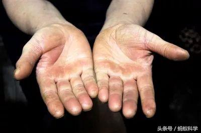 去除前脚掌老茧最佳方法,手上老茧怎么去除小窍门