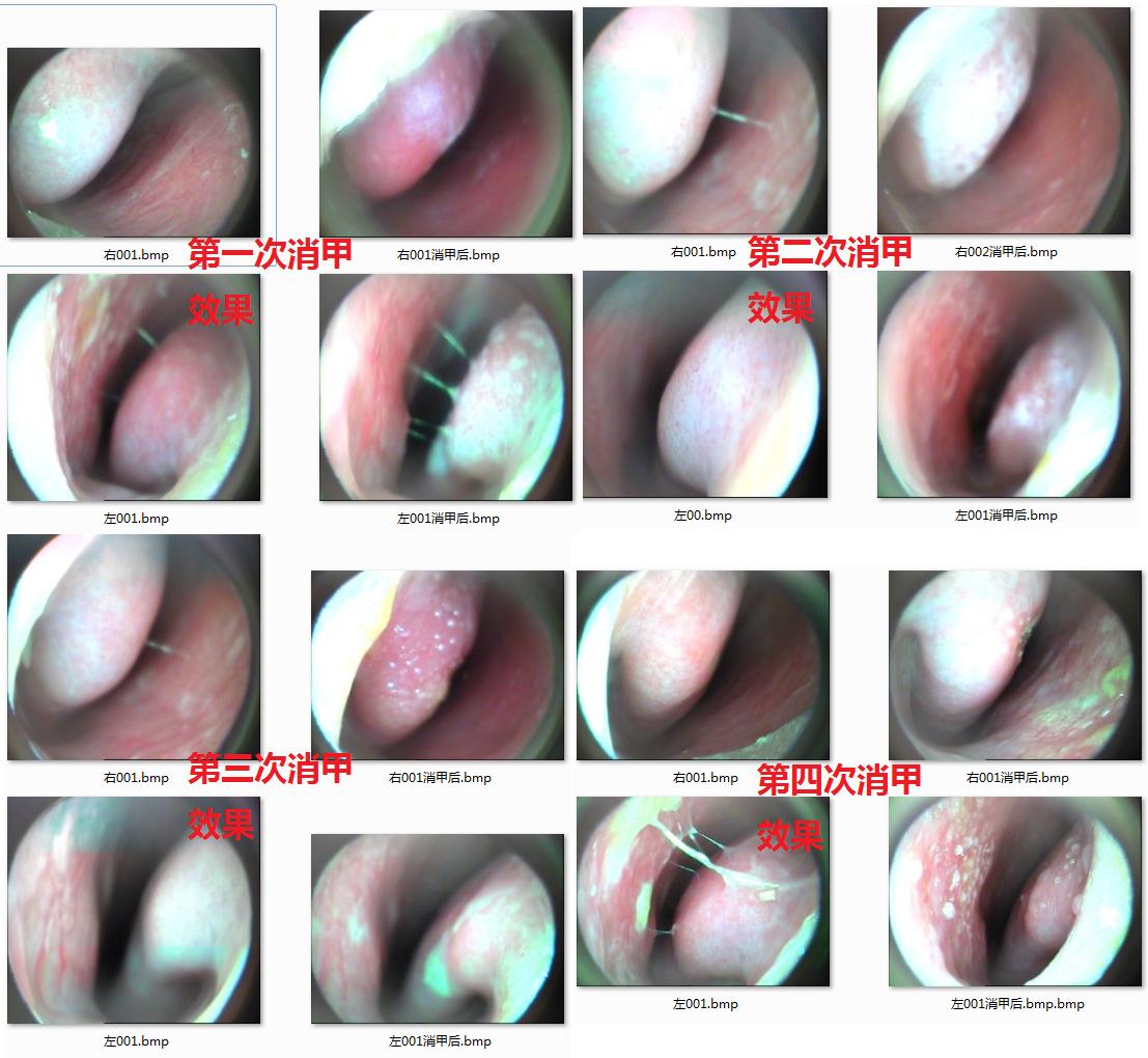 静子谈养生,中医治疗鼻炎方法有哪些