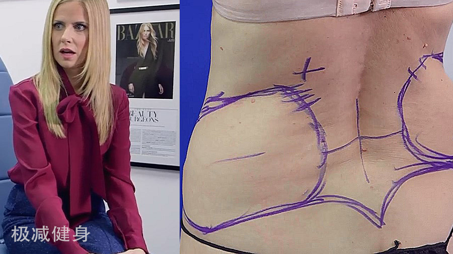 减肥抽脂的过程是怎样的,抽脂减肥的危害亲身经历