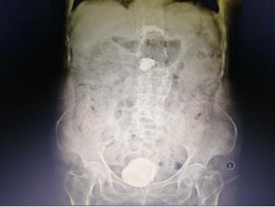 86岁老人膀胱结石建议手术吗,膀胱结石93岁老人