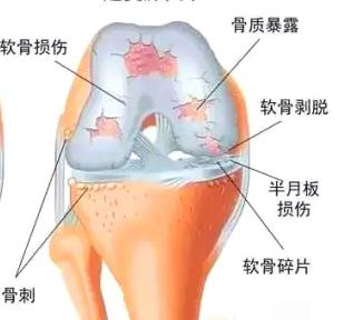 正确的跳绳姿势不会伤到膝盖,不正确的走路姿势引起膝盖疼
