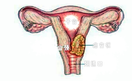 左小腹疼痛阴道流血是什么症状,下腹隐痛要警惕四种病白带多
