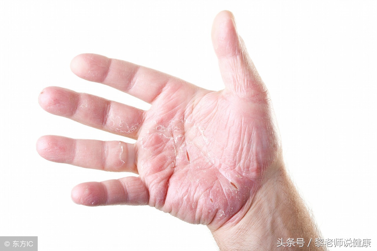 外耳道发炎湿疹,外耳道湿疹导致耳鸣可以自愈么