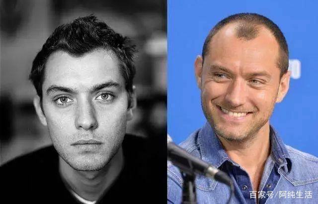 发际线脱发的原因和治疗方法,不要让发际线后移