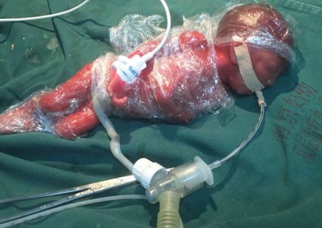 南京市妇幼28周早产儿能保住吗,国内存活的最小早产儿24周