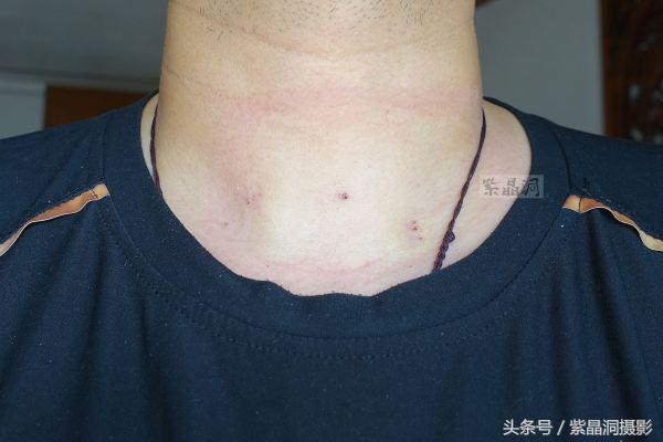 甲状腺结节手术需要住院几天出院,甲状腺结节做消融手术多少天出院