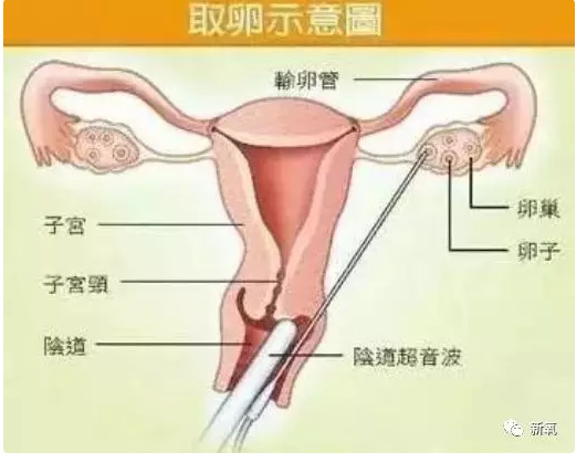 那些为了钱卖自己卵子的女生后来都怎样了？