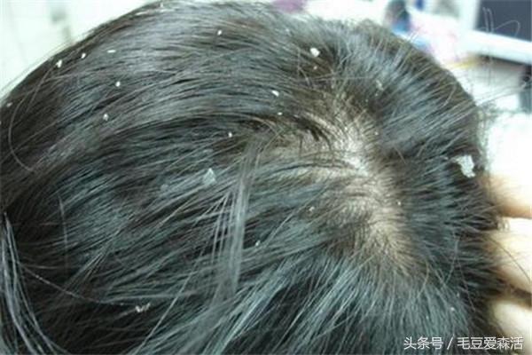 头上起大块的头屑怎么治,头上头屑真的是太多了怎么办