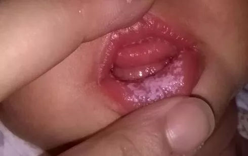 6个月宝宝口腔疾病有哪些,宝宝嘴疼可能与哪些口腔疾病有关