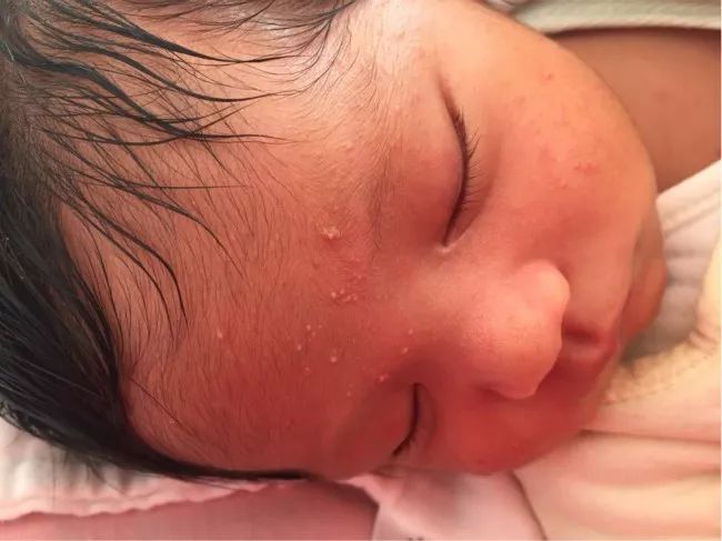 脂溢性皮炎和皮脂腺异位有关系吗,宝宝湿疹痤疮的区别