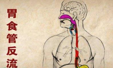 食管反流不反酸不烧心什么原因,反酸烧心胃食管反流怎么治